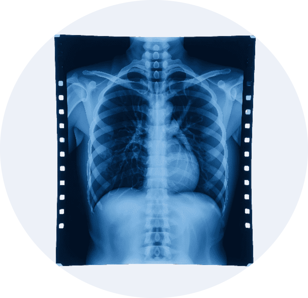 Chest X-ray image on film used for diagnostic radiology