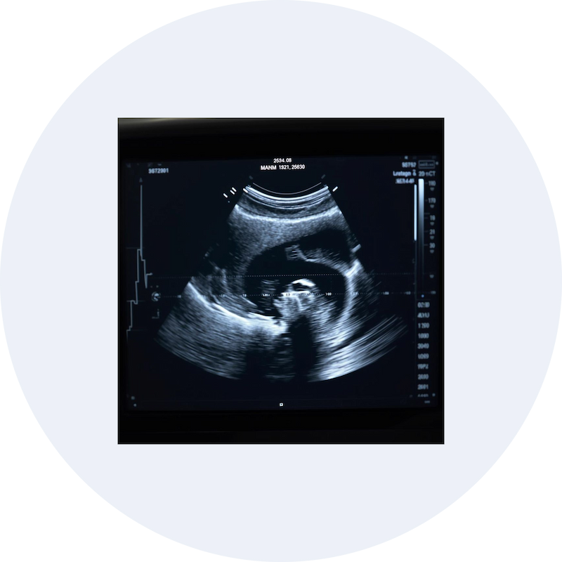 Ultrasound (sonography) scan image displayed on a monitor for diagnostic imaging